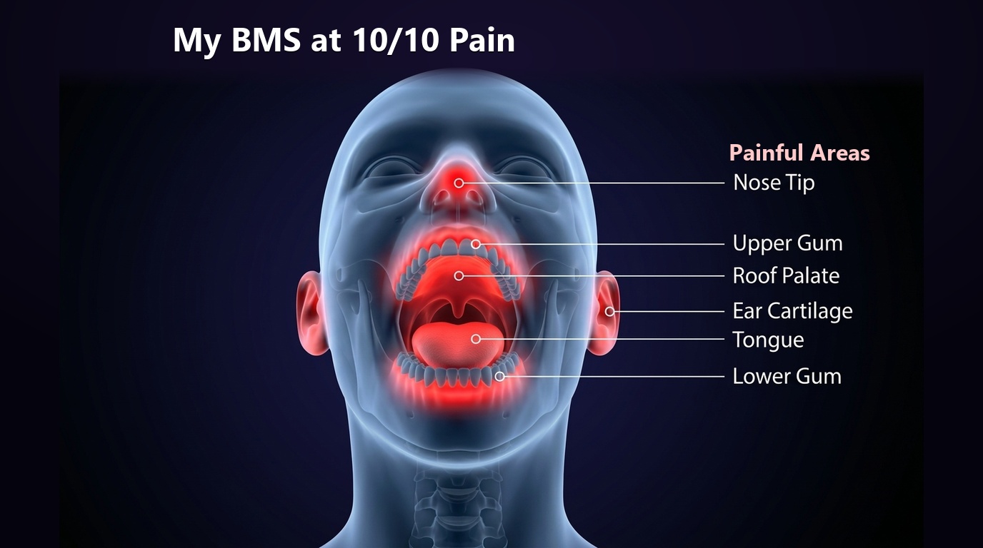 My BMS at 10/10 Pain: 3D medical visualization of human Trigeminal Nerve radiating pain showing glowing red hard palate, uvula, tongue, all upper and lower gums, nose tip, and ears